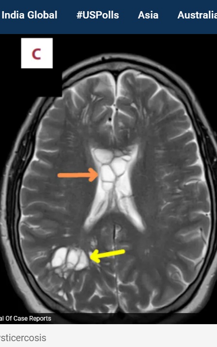 米フロリダ州に住む52歳男性の脳のCT検査の画像。医師はサナダムシの一種「有鉤条虫」の幼虫（嚢虫）が寄生し、脳の両半球が腫れ複数の嚢胞があることを発見した（『NDTV　「US Man Goes To Hospital With Migraines, Doctors Find Tapeworm In His Brain」（Image credit: American Journal of Case Reports）』より）