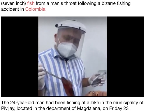 コロンビアの病院に2021年1月、24歳男性の喉から体長18センチの魚が摘出された。男性は釣りの最中に口にくわえた魚が喉の奥に潜り込み、窒息しかけたそうだ（『LADbible　「Doctors In Colombia Remove 18cm Fish From Man's Throat」』より）