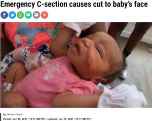 米コロラド州の病院で2021年6月、帝王切開で誕生した女児が手術時のメスにより顔に13針を縫う傷を負った。家族は病院から「赤ちゃんの顔が胎盤のすぐ近くにあった」と説明されるも、怒りを露わにしていた（『KRON4　「Emergency C-section causes cut to baby’s face」』より）
