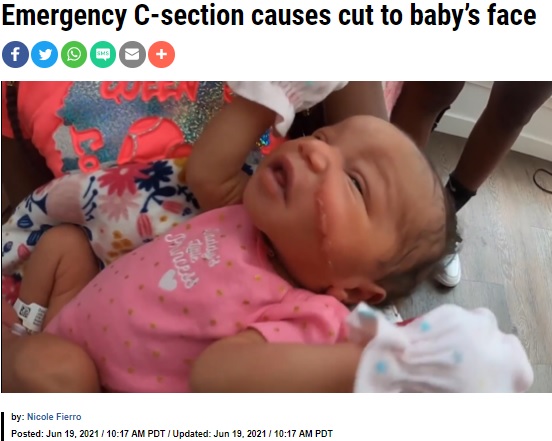 米コロラド州の病院で2021年6月、帝王切開で誕生した女児が手術時のメスにより顔に13針を縫う傷を負った。家族は病院から「赤ちゃんの顔が胎盤のすぐ近くにあった」と説明されるも、怒りを露わにしていた（『KRON4　「Emergency C-section causes cut to baby’s face」』より）