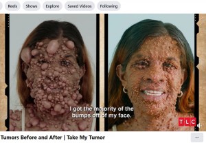 ライアン・オズボーン医師の手術を受けたトリニダード・トバゴの42歳女性。手術後に「人生は100％良くなったし、自分がとても美しいと感じることができる」と笑顔で語っていた（『TLC　Facebook「Tumors Before and After | Take My Tumor」』より）