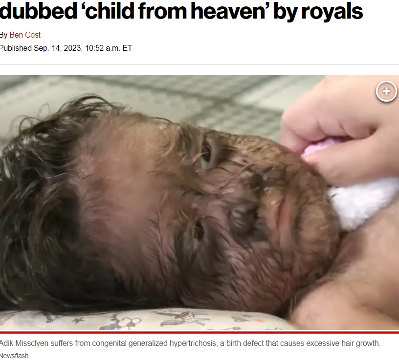 マレーシアに住む2歳の女児が2023年9月、世界中のメディアに伝えられた。女児は多毛症で、父親が娘の病気についてつらい胸のうちを語っていた（『New York Post　「Little girl born with ‘werewolf syndrome’ dubbed ‘child from heaven’ by royals」（Newsflash）』より）