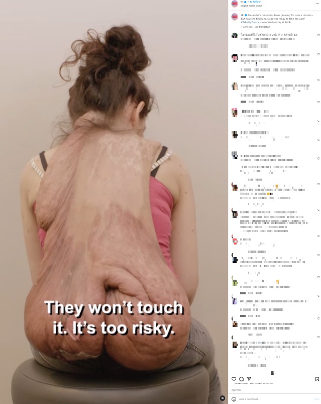 ライアン・オズボーン医師の手術を受けたドイツの30歳の女性。首の後ろにできたしこりが、20年以上をかけてまるでマントをぶら下げているかのように成長していた（『TLC　Instagram「Alexandra’s tumor has been growing for over a decade」』より）