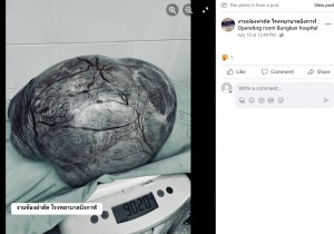 タイの病院で2023年7月、体重増加で悩んでいた女性の卵巣から巨大な腫瘍が摘出された。腫瘍はまるで光る岩のようで、9キロ超もあったという（『งานห้องผ่าตัด โรงพยาบาลบึงกาฬ : Operating room Bungkan hospital　Facebook「17/07/2566 TAH ＆ BSO」』より）