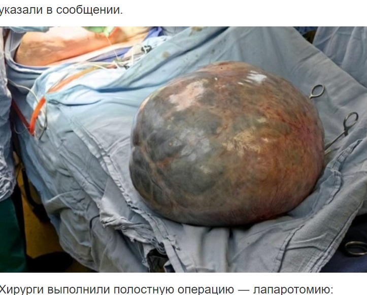 少し時間を置いて撮影された腫瘍はどす黒く変色しているのが分かる。重さ15キロ、直径は35センチほどあったそうで、手術後の経過は良いという（『СИА-ПРЕСС　「Жительнице Сургутского района удалили 15-килограммовую опухоль」』より）