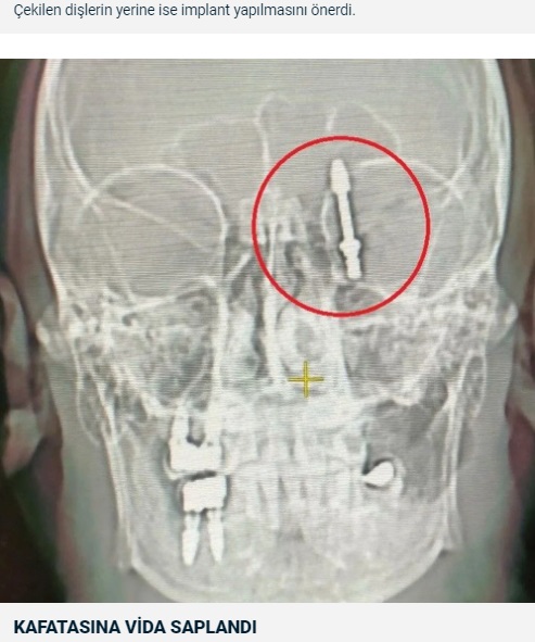 スクリューは上顎の骨を貫通し、眼球を支えている薄い骨（眼窩底）に突き刺さっていた。慌てた歯科医師は自ら車を運転し、ラマザンさんを地元のウルダー大学病院の救急外来に連れて行き、そのまま逃げてしまった（『NTV Haber　「İmplant tedavisinde vida beynine saplandı: Yanlış tedavi hayatını kararttı」』より）