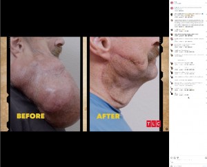 5時間近くに及んだ手術のビフォーアフター。顔から首にかけての腫瘍約2.5キロが切除され、形成手術が行われた（『TLC　Instagram「After 16 years, Tim is clean shaven and tumor-free!」』より）