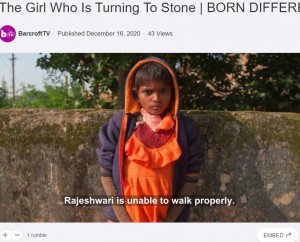 印チャッティースガル州に住む少女は、非常に稀な皮膚病「魚鱗癬」を患っている。2020年当時9歳でようやく治療が始まったことが伝えられていた（『Rumble　「The Girl Who Is Turning To Stone | BORN DIFFERENT」』より）