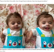 【海外発！Breaking News】クシャミで骨折し「長くは生きられない」と言われた“奇跡”の双子、8月で4歳に！（米）＜動画あり＞