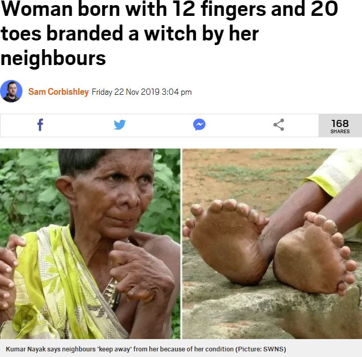 印オリッサ州ガンジャム地区在住で、足指20本と手指12本を持つ女性。2019年にメディアのインタビューに応じ、近所の人に「魔女だから近づくな」と忌み嫌われながら63年間生きてきたことを明かしていた（『Metro　「Woman born with 12 fingers and 20 toes branded a witch by her neighbours」（Picture: SWNS）』より）