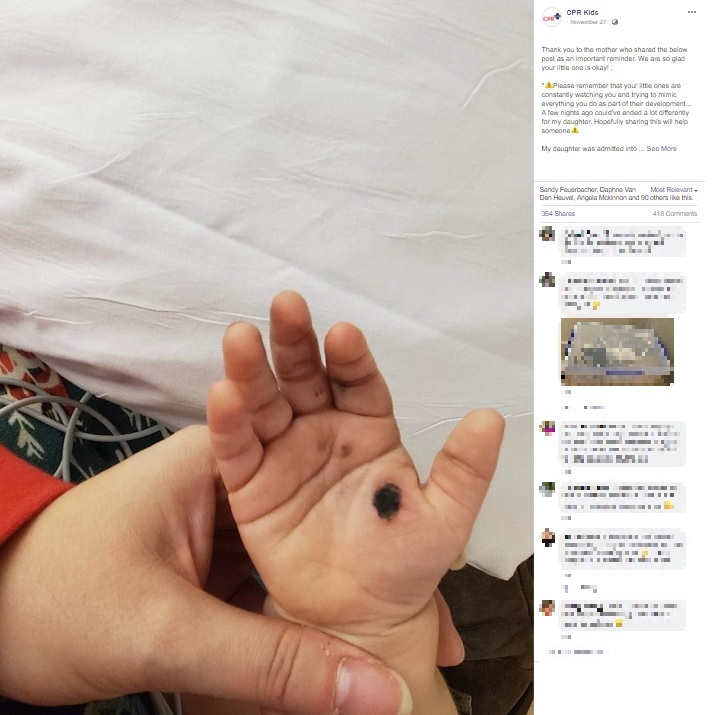 オーストラリアに住む女性が2019年11月、Facebookに投稿した写真。「私の娘は、スマホの充電器をコンセントに差し込もうとして感電し、入院しました」と綴られていた（『CPR Kids　Facebook「Thank you to the mother who shared the below post as an important reminder.」』より）