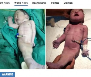 インドのコルカタで2017年12月、当時23歳だったムスクラ・ビビさんが出産したシレノメリアの赤ちゃん。誕生から4時間後に亡くなった（『The Sun　「MERMAID BABY Mum gives birth to ‘real life mermaid’ baby that tragically died just four hours later」』より）