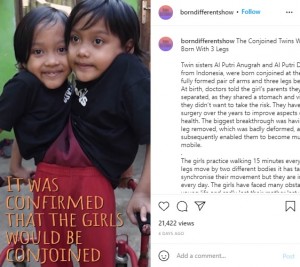 インドネシアで2021年、「誕生しても生存はできない」と言われた結合双生児の姉妹が8歳を迎えた。2人はそれぞれに2本の腕と1本の脚があり、身体の真ん中には変形した3本目の脚があった（『Born Different　Instagram「The Conjoined Twins Who Were Born With 3 Legs」』より）
