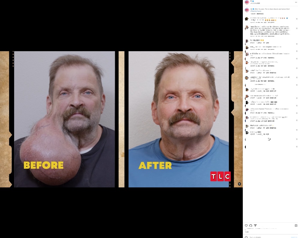 顔の右側に16年かけて成長したスイカ大の腫瘍があった米アリゾナ州に住む男性。手術で切除し「軽く楽になった」と語っていた（『TLC　Instagram「After 16 years, Tim is clean shaven and tumor-free!」』より）