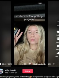 【海外発！Breaking News】妊娠した女性、鼻が肥大化して別人のようになり「こんなに変わるの？」＜動画あり＞