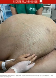 ブラジル在住の45歳の女性の腹部から2022年8月、約46キロの腫瘍が摘出された。担当外科医は「これほど大きい腫瘍は初めて」と驚愕していた（『G1　「Tumor com cerca de 46 kg é retirado de mulher em cirurgia de emergência em Itaperuna, no RJ」（Foto: Reprodução/Instagram）』より）