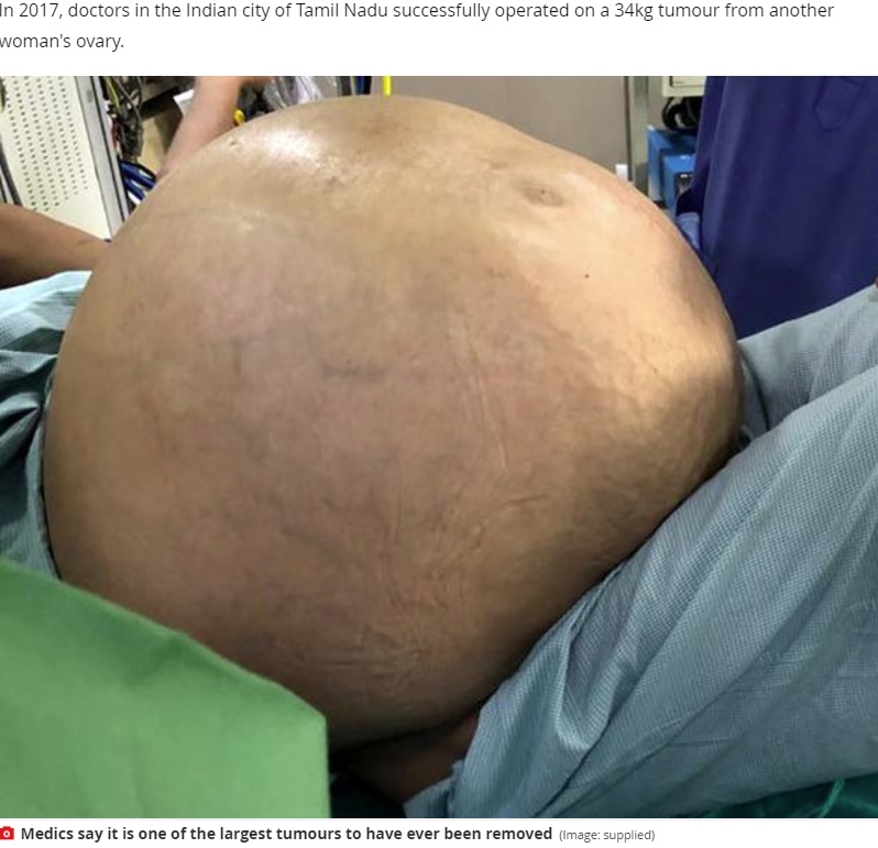 インドのデリーにある病院で2020年8月、52歳の女性が50キロの腫瘍を摘出していた。手術前の女性は体重が106キロに達していたという（『Mirror　「Huge ovarian tumour weighing almost 8 stone removed from 52-year-old woman」（Image: supplied）』より）