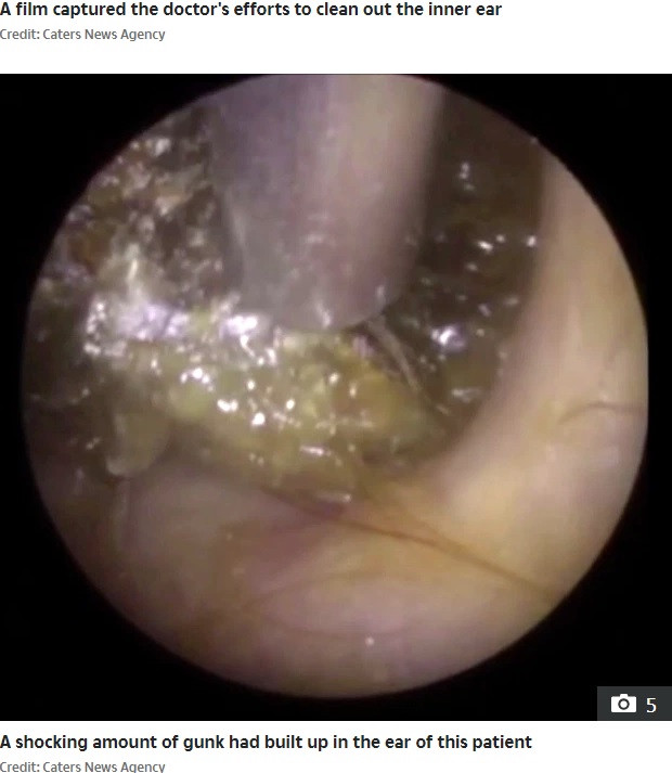 ライサシャ医師は2020年、16年間耳掃除をしなかった男性を診察した。「耳垢の量はこれまでで最高」と驚いていた（『The Sun　「EAR TODAY GONE TOMORROW Stomach-churning video shows audiologist removing 16 YEARS worth of ear wax from patient」（Credit: Caters News Agency）』より）