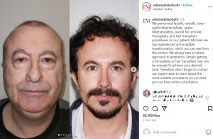 マイケルさんのビフォーアフターには「まるで父親と息子の写真」といった声が寄せられている（『Facial Plastic Surgery, Dental Treatment and Cosmetic Products　Instagram「We performed facelift, necklift, lower eyelid blepharoplasty」』より）