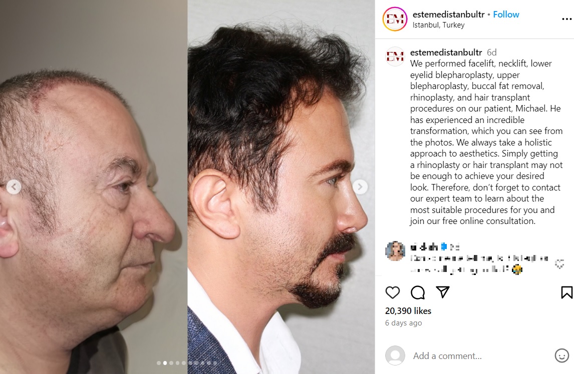 横から見ても同一人物とは思えないほどの変貌ぶり（『Facial Plastic Surgery, Dental Treatment and Cosmetic Products　Instagram「We performed facelift, necklift, lower eyelid blepharoplasty」』より）