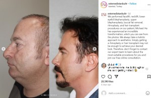 髪の毛は植毛手術によって豊かにフサフサになっていた（『Facial Plastic Surgery, Dental Treatment and Cosmetic Products　Instagram「We performed facelift, necklift, lower eyelid blepharoplasty」』より）