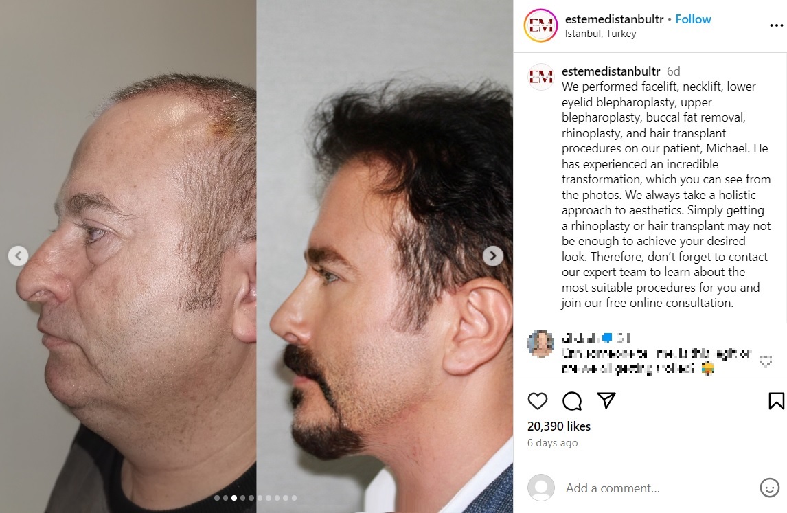 髪の毛は植毛手術によって豊かにフサフサになっていた（『Facial Plastic Surgery, Dental Treatment and Cosmetic Products　Instagram「We performed facelift, necklift, lower eyelid blepharoplasty」』より）