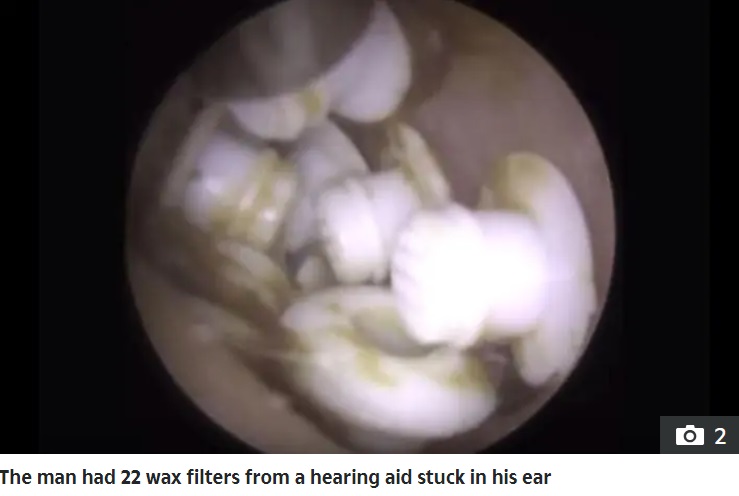 経験豊富なライサシャ医師でも衝撃を受けたという補聴器の耳垢防止フィルター。男性の耳の中から22個を摘出したという（『The Sun　「EAR WE GO Man has 22 objects removed from his ear - after they kept falling off his hearing aid」』より）