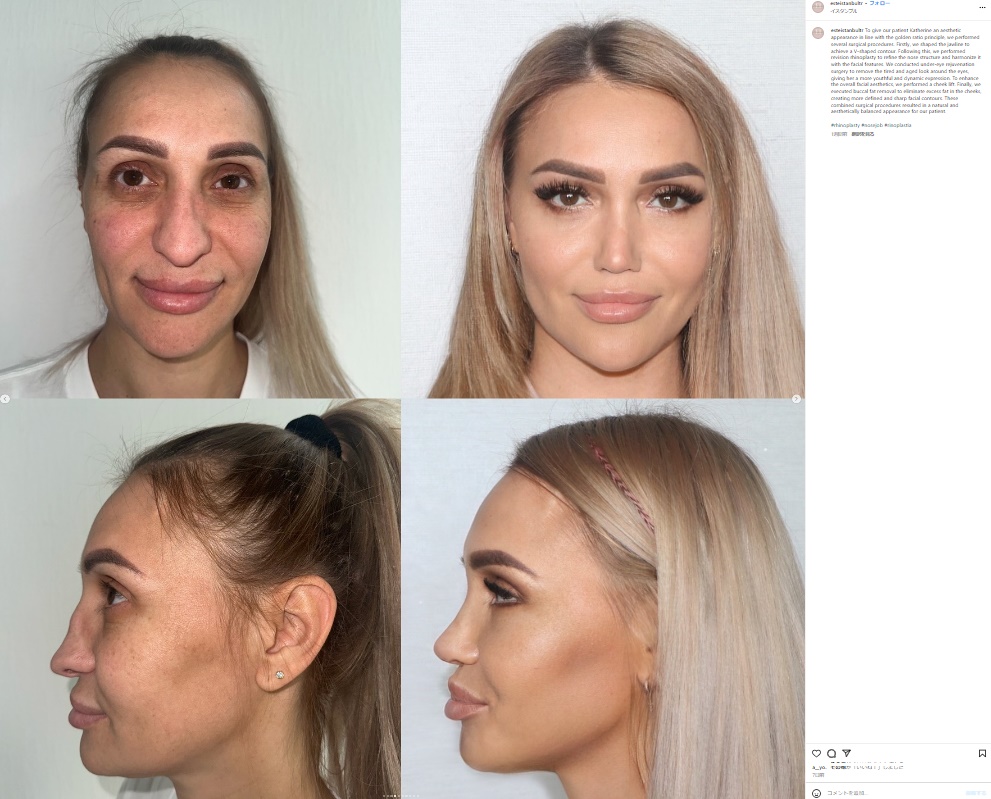 顎のVライン形成、鼻尖形成、目の下のたるみ取り、頬のリフト、頬の脂肪（バッカルファット）除去を行ったキャサリンさんのビフォーアフター写真（『Facial Plastic Surgery, Dental Treatment and Cosmetic Products　Instagram「To give our patient Katherine an aesthetic appearance in line」』より）