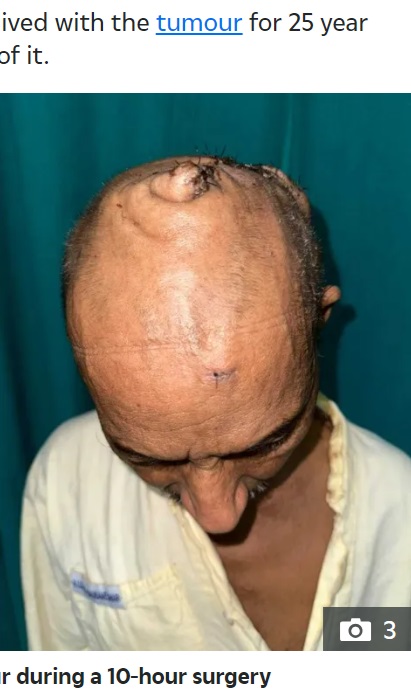 インド東部にある全インド医科大学のチームが今年5月、51歳の男性の頭にあった7キロの腫瘍を無事切除したことをSNSで報告。腫瘍は25年前に発生し、直近の7か月で急速に成長したという（『The Sun　「‘LIFE-CHANGING’ Incredible transformation as man, 51, has giant head tumour removed in intricate 10-hour operation」』より）