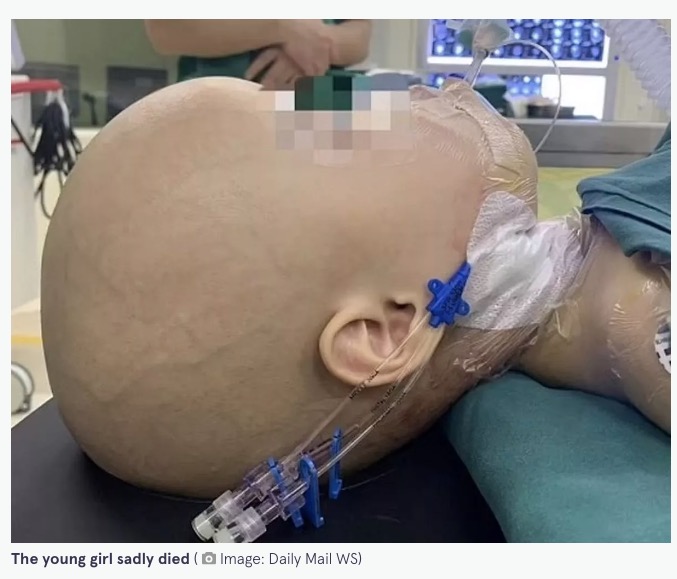 開頭手術を受けた女児。手術から12日後に亡くなったという（『The Mirror　「Doctors discover one-year-old girl has foetus growing in skull that was her twin sister」（Image: Daily Mail WS）』より）