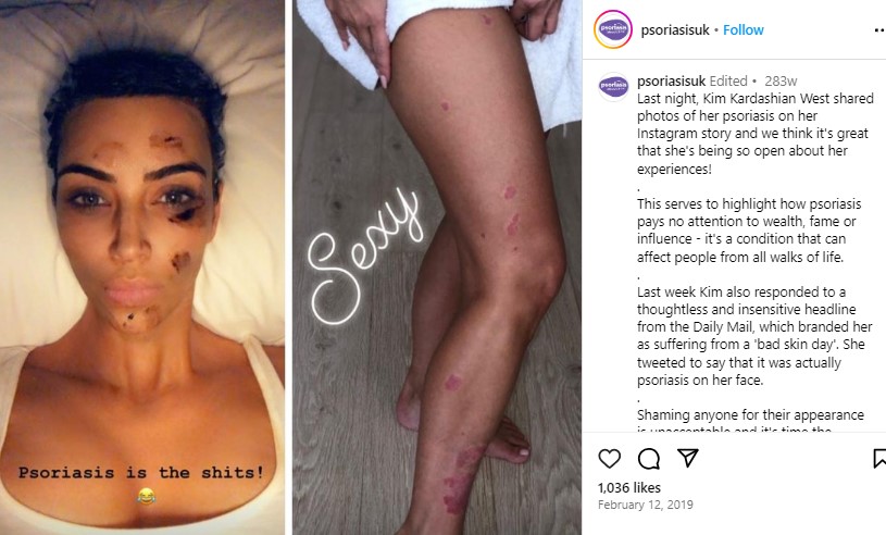2019年、キムが公開した「乾癬」の症状。顔や脚に大きな赤い発疹ができている（『Psoriasis Association　Instagram「Last night, Kim Kardashian West shared photos of her psoriasis on her Instagram story」』より）
