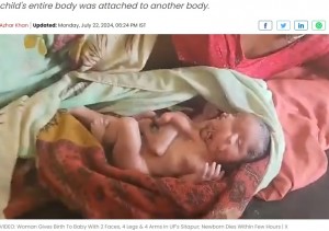 頭蓋骨の形が異常で顔が2つある顔面重複奇形（二顔体）の赤ちゃん。胸から飛び出すように未発達の腕2本と脚2本が生えていた（『Free Press Journal　「VIDEO: Woman Gives Birth To Baby With 2 Faces, 4 Legs & 4 Arms In UP's Sitapur; Newborn Dies Within Few Hours」』より）
