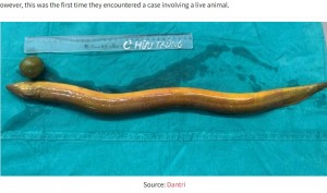 手術で摘出された大きなウナギとライム。フイ医師は「肛門から生きた動物を挿入することは危険」と注意喚起した（『MustShareNews　「Man in Vietnam stuffs 65cm live eel into anus, suffers intestinal rupture ＆ severe pain」（Source: Dantri）』より）