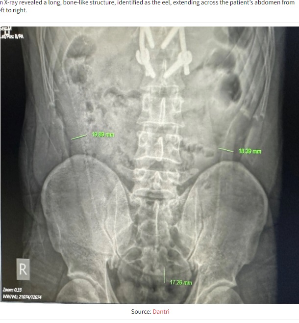 肛門から生きたウナギを挿入したインド人男性（31）のレントゲン写真。医師はウナギと分かるような長い骨が男性の腹部を横切るように左から右へ伸びていることに気付いた（『MustShareNews　「Man in Vietnam stuffs 65cm live eel into anus, suffers intestinal rupture ＆ severe pain」（Source: Dantri）』より）