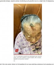 【海外発！Breaking News】107歳のおばあちゃん、額から生えた10センチの“角”が話題に（中国）＜動画あり＞