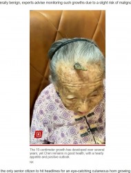 【海外発！Breaking News】107歳のおばあちゃん、額から生えた10センチの“角”が話題に（中国）＜動画あり＞